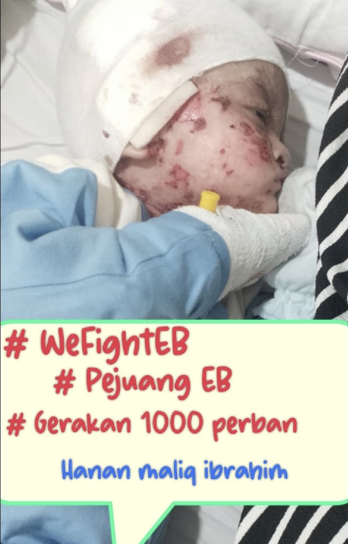 We are fighting EB. We have supplied over 1000 bandagesto sufferers of EB.